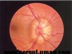 Nevrita optica (optic neuritis) – inflamarea nervului optic