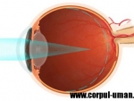Miopia – defect de vedere