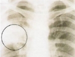 Pneumonie- Complicatii