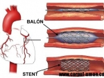 Angioplastia sau balonarea coronara – Cand o faceti si la ce va ajuta?