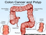 O noua metoda de diagnosticare a cancerului de colon