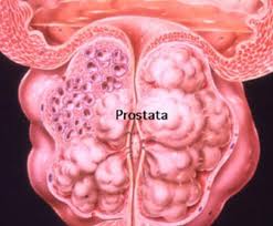 Ce oase afecteaza cancerul de prostata