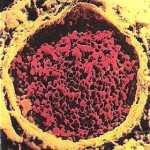 Această imagine microscopică arată prezenţa unui cheag de sânge în interiorul plămânului (embolism pulmonar). In unele cazuri, presiunea sângelui în plămâni devine ridicată.