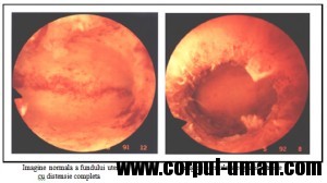 Histeroscopia panoramica