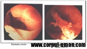 Histeroscopia