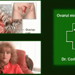 Ovar Micropolichistic