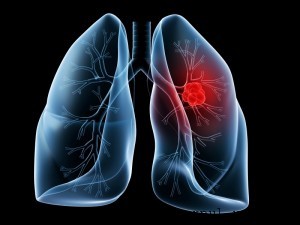 Tratament pentru cancer pulmonar