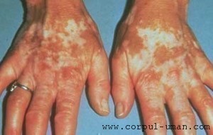 Tratament vitiligo