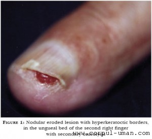 ciuperca unghiei onicoliza unghiilor