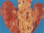 Malformaţiile congenitale ale tractului urinar