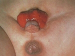 Malformaţii ale ureterului