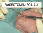 Despre Vasectomie