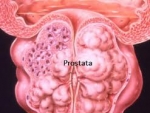 Cancerul de prostata,depistat in urina… Stiati ca?