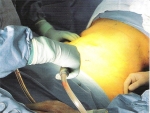 Chirurgie plastică si reparatorie