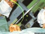 Laserul in chirurgia ginecologică