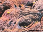 Boala celiaca