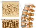 Osteoporoza (os poros) – boala a oaselor, frecventa la varstnici