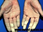 Sindromul Raynaud – sindromul mainilor reci