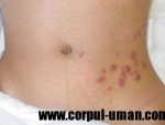 Zona zoster (herpes-zoster) – boala dermatologica
