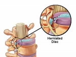 Hernia de disc – simptome si tratament