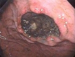 Ulcerul gastric (boala a stomacului)