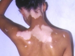 Vitiligo – depigmentare a pielii