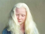 Albinismul – tipurile de albinism