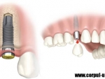 Implantul dentar – etape si noutati