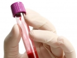 Anemia – Aflati totul despre anemie
