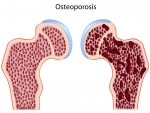 Cum poti preveni osteoporoza si fracturile?