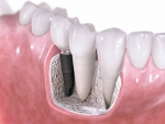 Alegerea implantului dentar