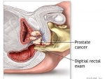 Noua cauza pentru aparitia cancerului de prostata