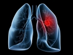Studiu: Cum se poate vindeca cancerul pulmonar?