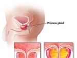 Prostata – Tratament naturist
