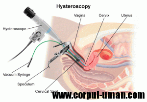 histeroscopia