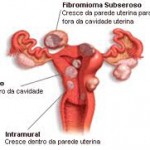 Candidoza vaginala