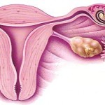 Sarcina extrauterina