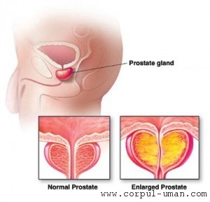 Prostata: tratament naturist